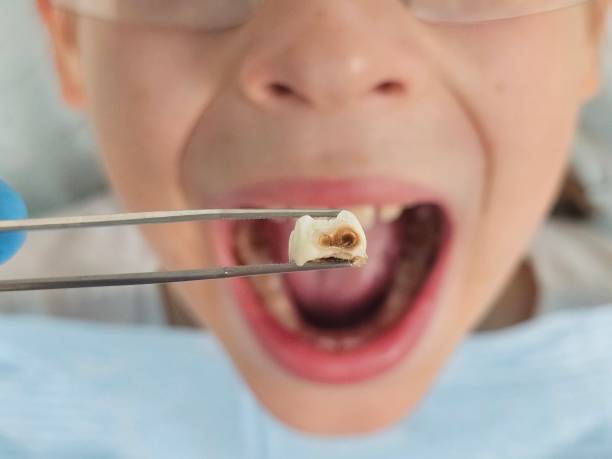 Best Emergency Tooth Extraction in Burnettown, SC